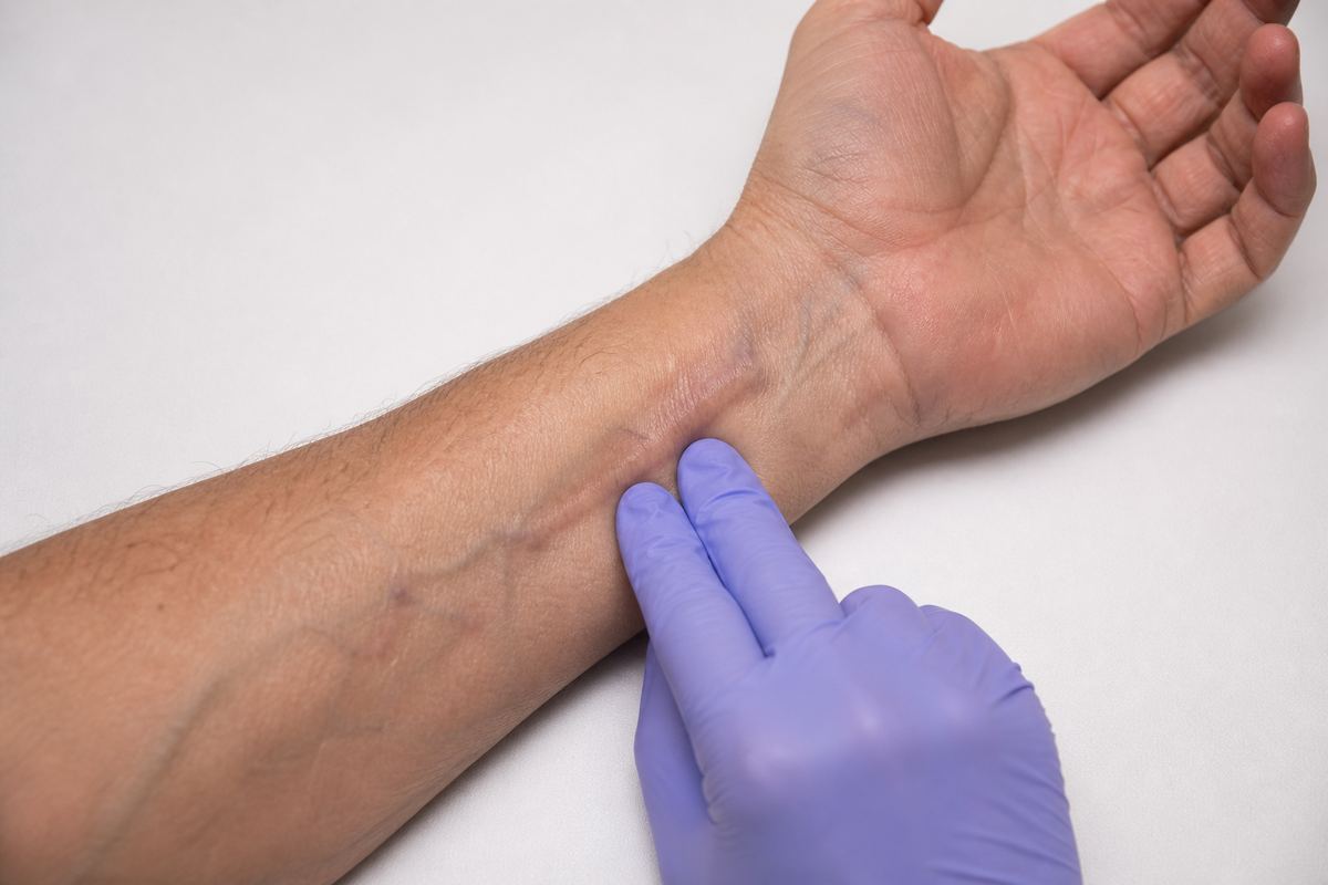 Gloved fingers palpating a mature arteriovenous fistula on the forearm for thrill.